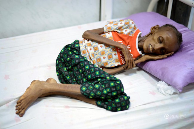 Cô gái Yemen 18 tuổi với thân hình còi cọc đến mức khó tin đã có thể mỉm cười trở lại - Ảnh 1.