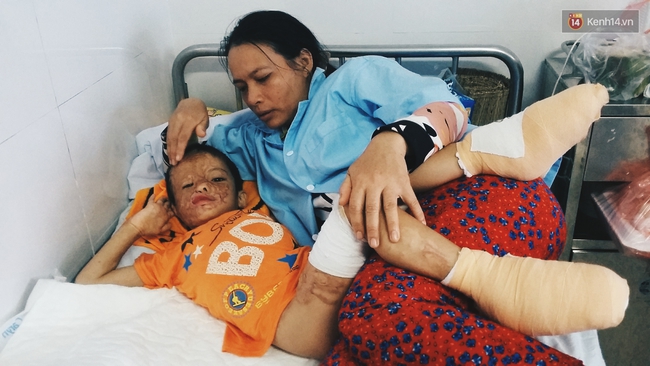 Cậu b&eacute; 5 tuổi bị bỏng đến biến dạng v&igrave; anh trai nướng hạt điều cạnh đống rơm - Ảnh 3.