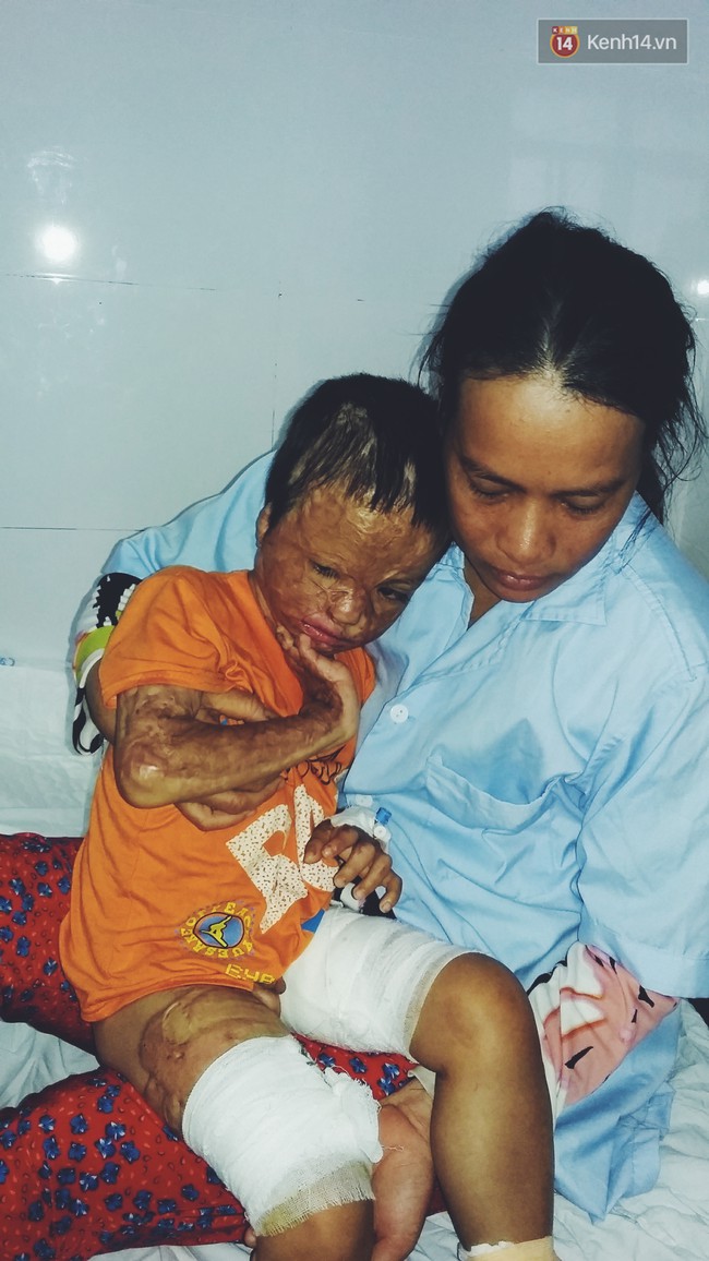 Cậu b&eacute; 5 tuổi bị bỏng đến biến dạng v&igrave; anh trai nướng hạt điều cạnh đống rơm - Ảnh 2.