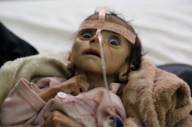 Những thân hình chỉ còn da bọc xương gây sốc: Cả một thế hệ của Yemen đang đứng trước nguy cơ diệt vong vì nạn - Ảnh 3.