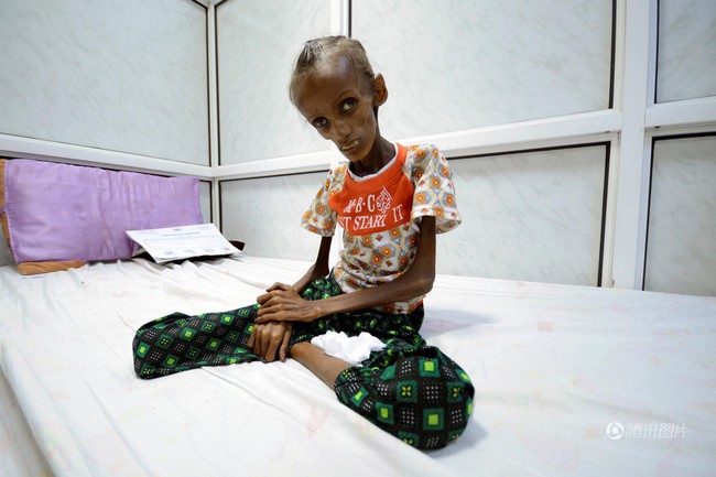 Cô gái Yemen 18 tuổi với thân hình còi cọc đến mức khó tin đã có thể mỉm cười trở lại - Ảnh 2.