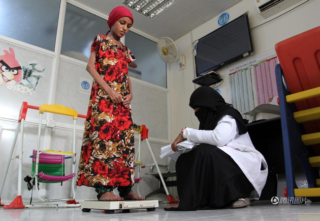 Cô gái Yemen 18 tuổi với thân hình còi cọc đến mức khó tin đã có thể mỉm cười trở lại - Ảnh 8.