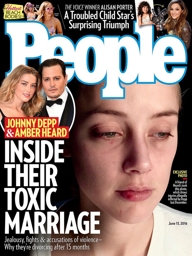 Amber Heard tung th&ecirc;m ảnh mặt bầm t&iacute;m, tin nhắn tố Johnny Depp bạo h&agrave;nh - Ảnh 1.