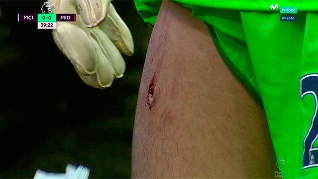 Victor Valdes r&aacute;ch to&aacute;c đ&ugrave;i sau c&uacute; đạp gầm gi&agrave;y của đối thủ - Ảnh 3.