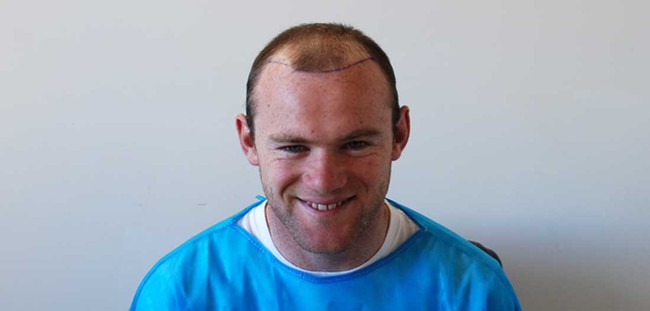Chi cả tỷ đồng cứu chữa, t&oacute;c của Rooney vẫn lơ thơ như &ocirc;ng gi&agrave; - Ảnh 4.