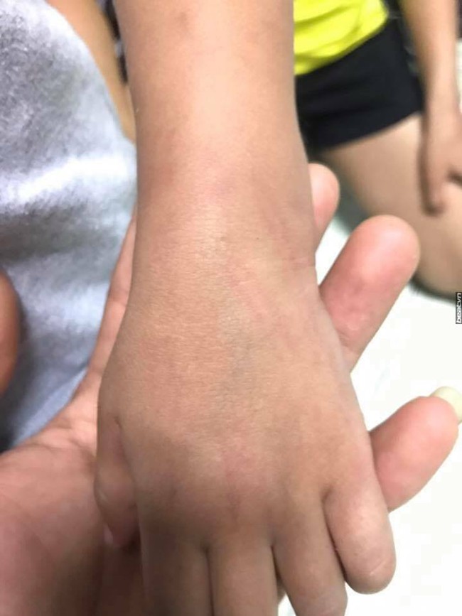 Cô giáo rối rít xin lỗi phụ huynh vì vô tình đánh gãy tay bé trai 3 tuổi ở trường mầm non - Ảnh 4.