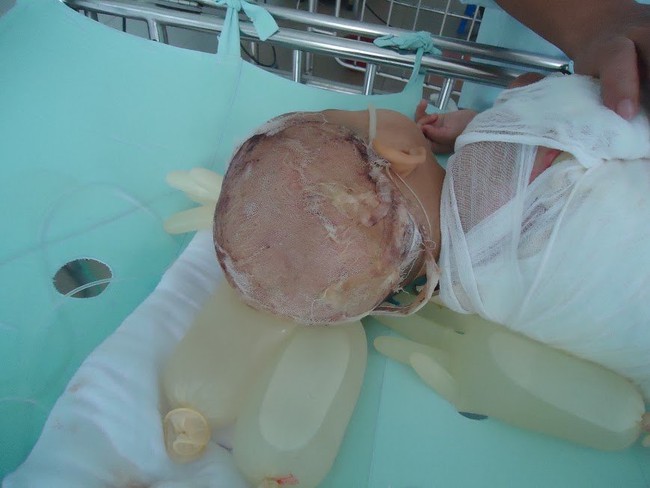 Ng&atilde; v&agrave;o nồi canh n&oacute;ng, b&eacute; g&aacute;i 17 th&aacute;ng tuổi nguy kịch - Ảnh 2.