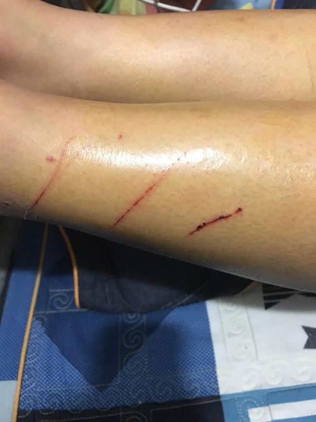 Nghi vấn: Xuất hiện đối tượng rạch đ&ugrave;i thiếu nữ tại H&agrave; Nội? - Ảnh 3.