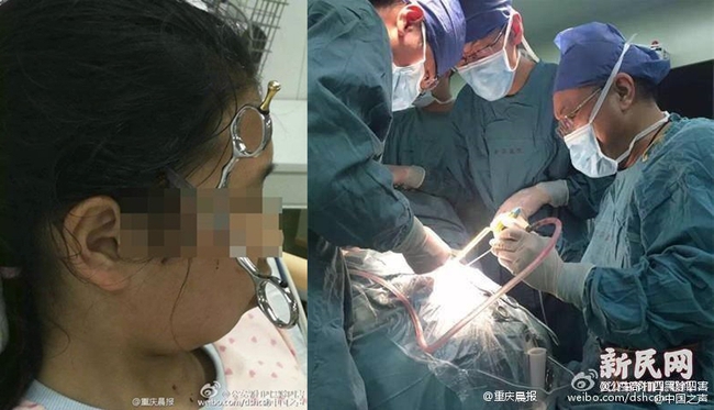 Bắt con l&agrave;m b&agrave;i tập kh&ocirc;ng được, cha lỡ tay phi k&eacute;o cắm v&agrave;o đầu con g&aacute;i - Ảnh 1.