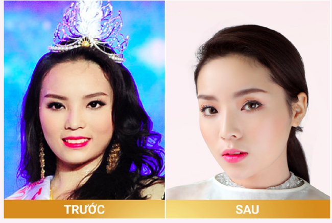 Bằng chứng cho thấy Hoa hậu Kỳ Duy&ecirc;n n&oacute;i dối chuyện thẩm mỹ - Ảnh 7.