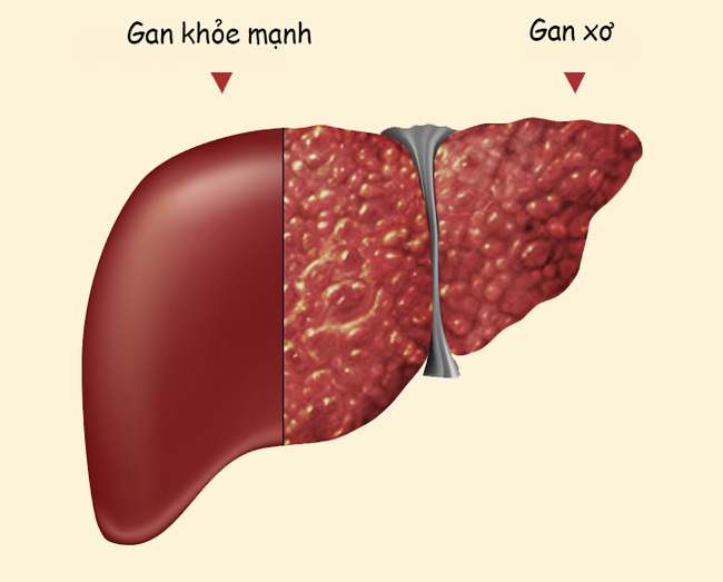 Viêm gan - sát thủ ngầm cực nguy hiểm với sức khoẻ của chúng ta - Ảnh 1.