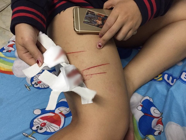 Cô gái trẻ phải điều trị phơi nhiễm HIV khi bị nhóm biến thái rạch đùi trong đêm ở Sài Gòn - Ảnh 2.