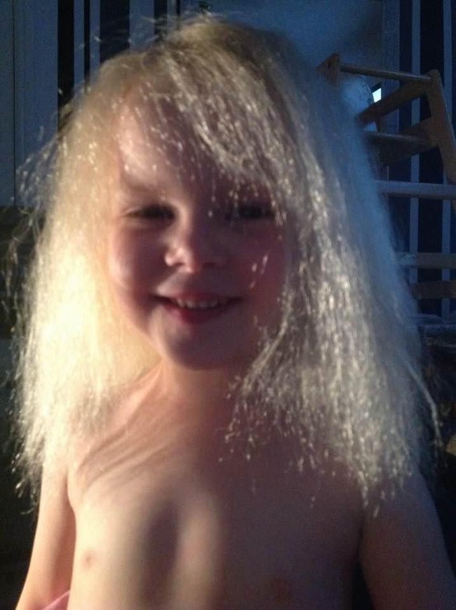 Bé gái 5 tuổi mắc bệnh tóc chổi rơm giống nhà bác học Einstein - Ảnh 4.