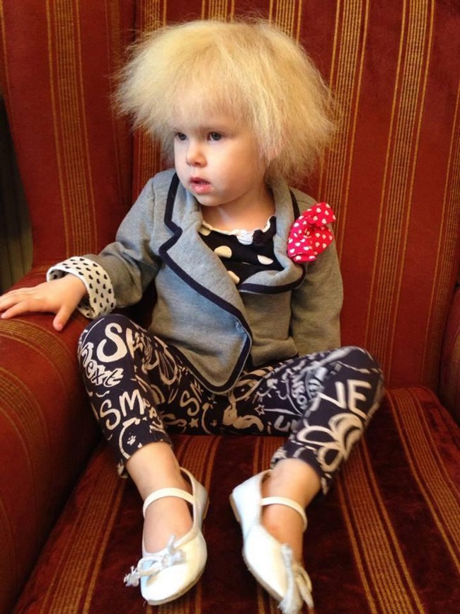 Bé gái 5 tuổi mắc bệnh tóc chổi rơm giống nhà bác học Einstein - Ảnh 3.