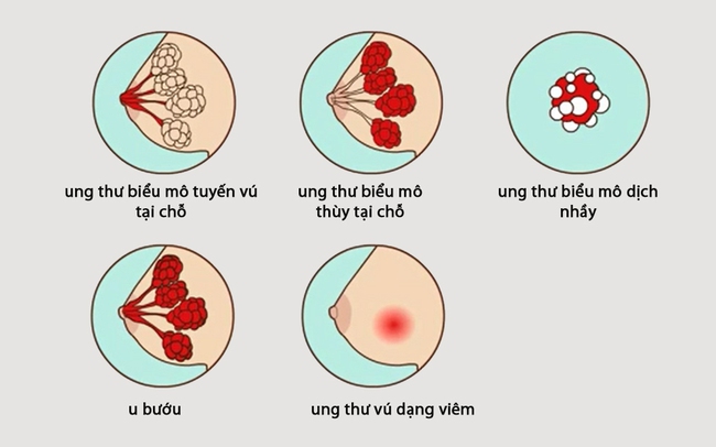 Cẩn trọng với thói quen mặc áo ngực quá chật vì nó có thể gây ra các bệnh nguy hiểm - Ảnh 2.