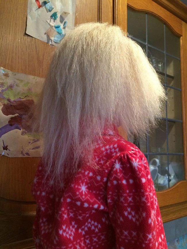 Bé gái 5 tuổi mắc bệnh tóc chổi rơm giống nhà bác học Einstein - Ảnh 2.