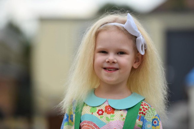 Bé gái 5 tuổi mắc bệnh tóc chổi rơm giống nhà bác học Einstein - Ảnh 1.