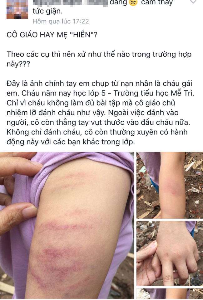 Hà Nội: Cô giáo chủ nhiệm dùng thước đánh bầm tím tay học sinh vì không học bài - Ảnh 1.