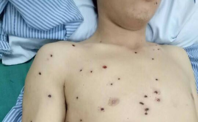 Đang đi đường bị n&atilde; đạn hoa cải khắp cơ thể - Ảnh 1.
