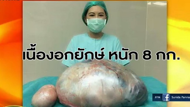 Tưởng béo phì, bệnh nhân đi khám và phát hiện ra khối u khổng lồ trong buồng trứng nặng 8kg - Ảnh 2.