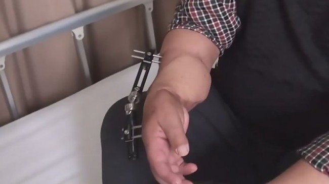 B&agrave;n tay mọc l&ecirc;n ở cổ ch&acirc;n v&agrave; sự thật đằng sau đ&oacute; - Ảnh 2.