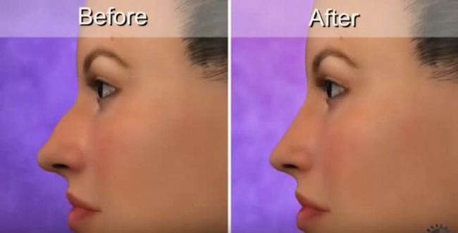 Phẫu thuật nâng mũi đơn giản không mà sao ngày càng nhiều người lựa chọn loại hình làm đẹp này - Ảnh 10.
