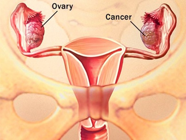 Còn trẻ cũng dễ mắc ung thư buồng trứng nếu bỏ qua những dấu hiệu này - Ảnh 1.