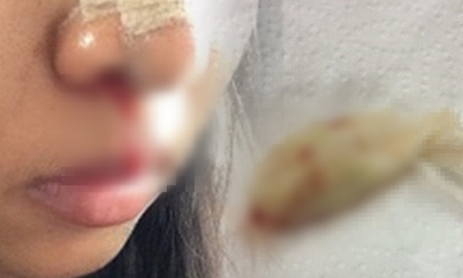Cô gái suýt tắc thở vì bác sĩ thẩm mỹ quên lấy băng gạc trong mũi bệnh nhân - Ảnh 1.