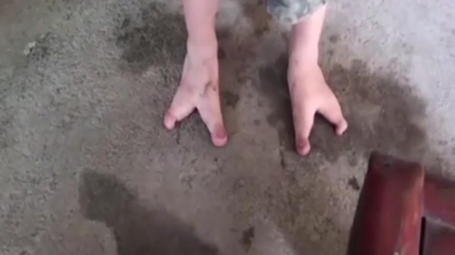 Đôi chân như cặp càng cua của bé trai hai ngón - Ảnh 1.