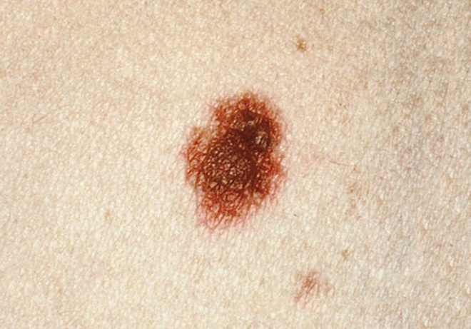 5 dấu hiệu bất thường ở nốt ruồi cảnh báo nguy cơ ung thư da - Ảnh 5.