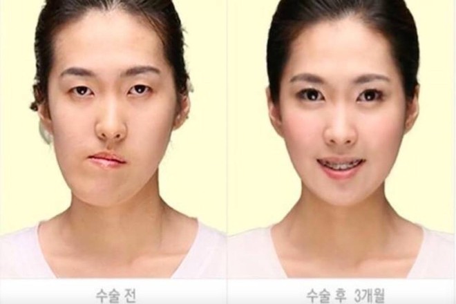 Người nước ngo&agrave;i đổ x&ocirc; đến H&agrave;n Quốc để phẫu thuật thẩm mỹ c&ograve;n nhiều hơn d&acirc;n bản địa - Ảnh 3.