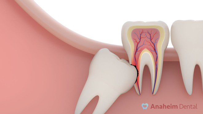 Tìm hiểu các triệu chứng khi mọc răng khôn để có cách đối phó tốt hơn - Ảnh 2.