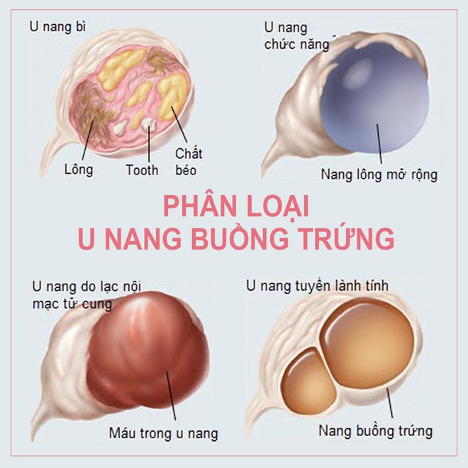 U nang buồng trứng và những điều cần lưu ý ngay để bảo vệ sức khỏe sinh sản tốt hơn - Ảnh 2.