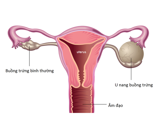 Con g&aacute;i cần lưu &yacute;: bị chuột r&uacute;t thường xuy&ecirc;n c&oacute; thể l&agrave; dấu hiệu của 5 bệnh phụ khoa nguy hiểm sau - Ảnh 2.