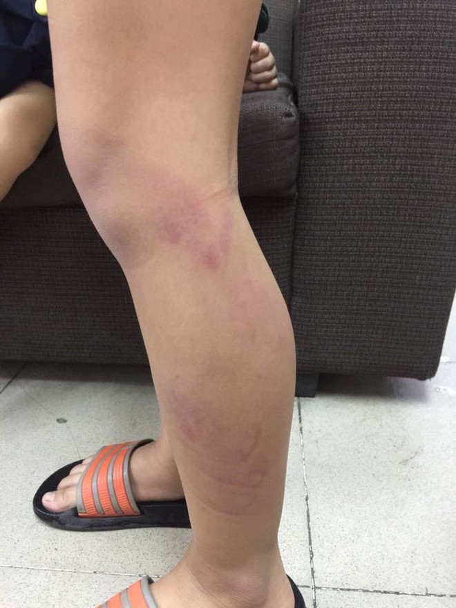 H&agrave; Nội: Học sinh lớp 2 bị c&ocirc; gi&aacute;o đ&aacute;nh g&atilde;y thước, th&acirc;m t&iacute;m hai ch&acirc;n do v&agrave;o lớp muộn sau giờ ra chơi - Ảnh 3.