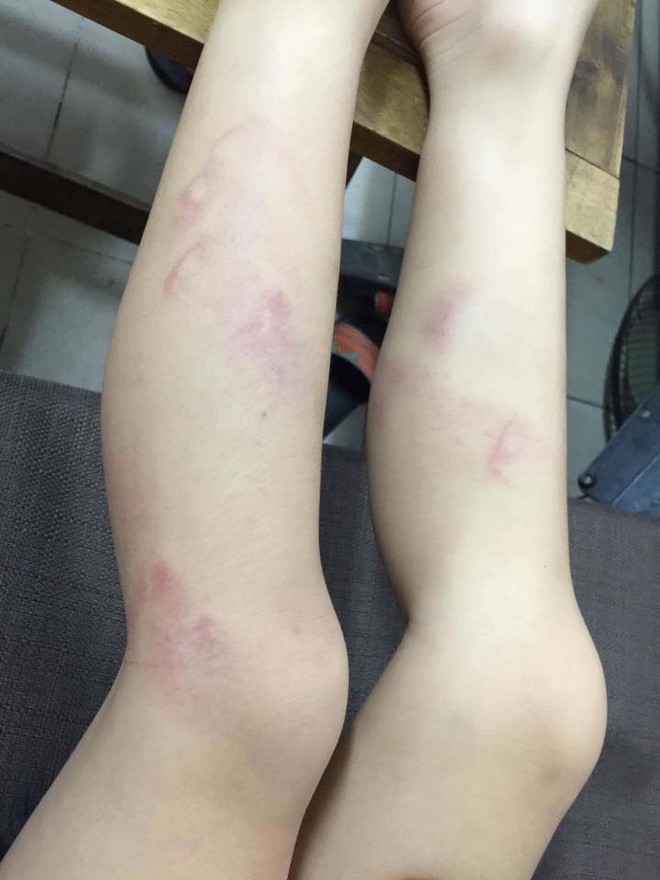 H&agrave; Nội: Học sinh lớp 2 bị c&ocirc; gi&aacute;o đ&aacute;nh g&atilde;y thước, th&acirc;m t&iacute;m hai ch&acirc;n do v&agrave;o lớp muộn sau giờ ra chơi - Ảnh 2.