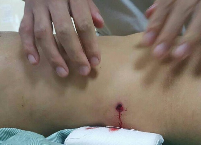 Vụ hai nh&oacute;m nổ s&uacute;ng hỗn chiến trong đ&ecirc;m tr&ecirc;n phố H&agrave; Nội: Một c&ocirc; g&aacute;i bị đạn xuy&ecirc;n thủng đại tr&agrave;ng, tho&aacute;t chết trong gang tấc - Ảnh 1.