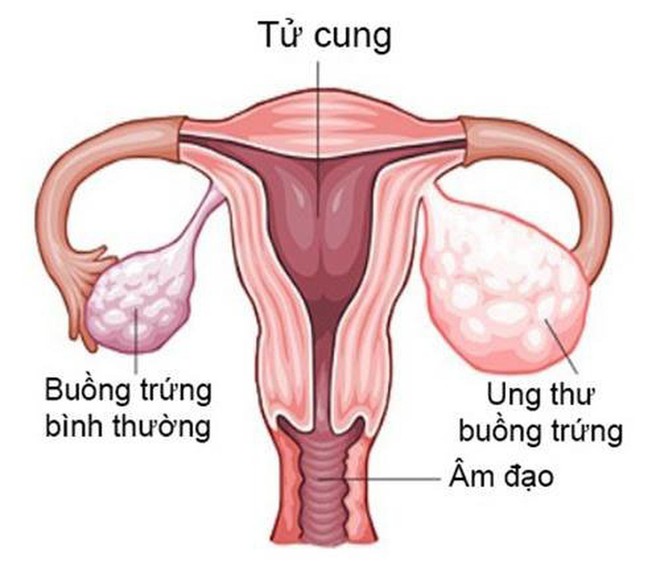 Con g&aacute;i cần lưu &yacute;: bị chuột r&uacute;t thường xuy&ecirc;n c&oacute; thể l&agrave; dấu hiệu của 5 bệnh phụ khoa nguy hiểm sau - Ảnh 4.