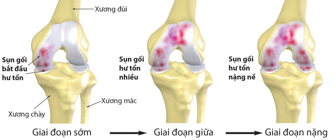 6 căn bệnh nguy hiểm mà người thừa cân, béo phì có nguy cơ cao mắc phải - Ảnh 1.