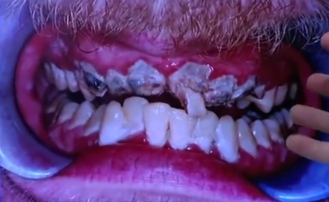 Anh chàng không bao giờ cười vì suốt 20 năm chẳng chịu đánh răng nổi lấy một lần - Ảnh 4.
