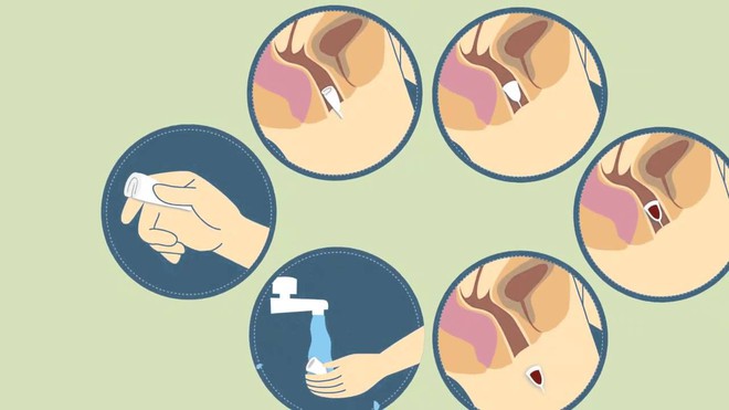 Trải nghiệm lần đầu d&ugrave;ng cốc nguyệt san: Từ thất bại nhớ đời đến cảm gi&aacute;c tr&ecirc;n cả tuyệt vời - Ảnh 3.