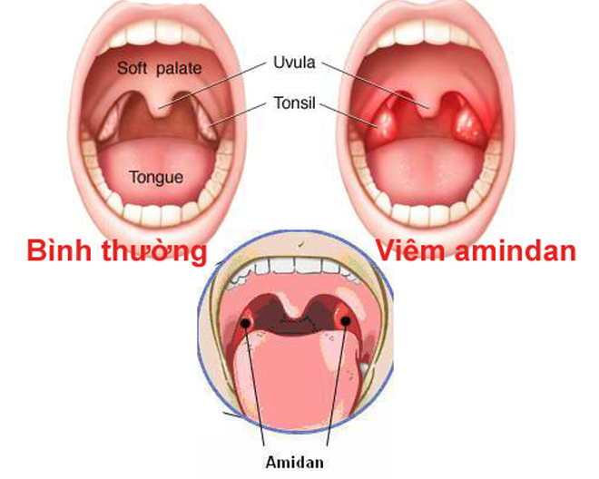 Hơi thở bỗng nhiên có mùi lạ, coi chừng cơ thể mắc các bệnh nguy hiểm - Ảnh 3.