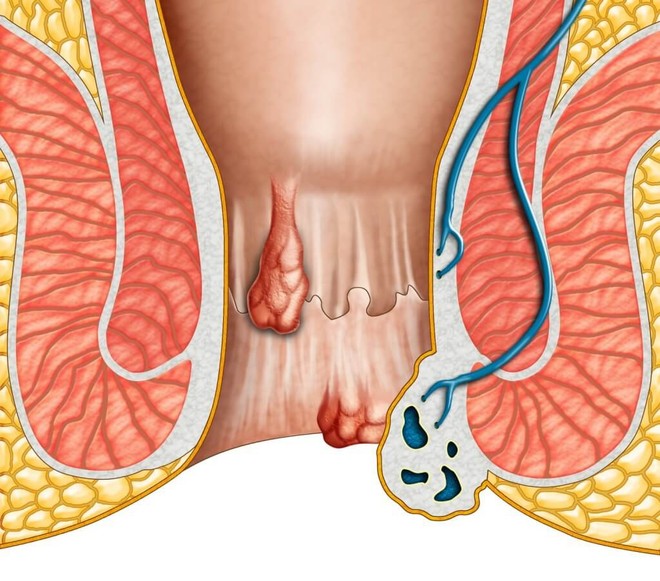 Câu chuyện thật của những người trẻ mắc bệnh trĩ: toàn nguyên nhân không ai ngờ - Ảnh 3.