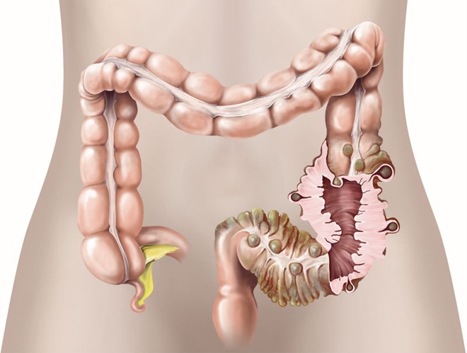 Người đ&agrave;n &ocirc;ng rơi v&agrave;o vi&ecirc;m tụy cấp t&iacute;nh v&igrave; ăn qu&aacute; nhiều thịt - đ&atilde; đến l&uacute;c kh&ocirc;ng thể chủ quan nữa - Ảnh 4.