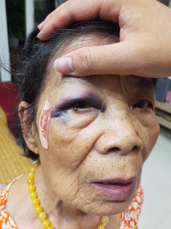 H&agrave; Nội: B&agrave; cụ 80 tuổi bị &ocirc; t&ocirc; đ&acirc;m bầm t&iacute;m mắt v&agrave; tay, t&agrave;i xế vờ xuống xem rồi viện l&yacute; do để bỏ chạy - Ảnh 2.