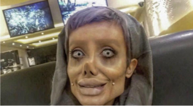 Cô gái phẫu thuật thẩm mỹ hơn 50 lần để nhìn giống Angelina Jolie, kết quả trả về gia tinh Dobby - Ảnh 2.