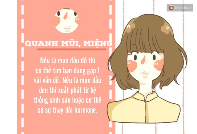 Nếu bạn đang có mụn, hãy kiểm tra ngay vị trí của chúng vì điều đó cũng nói lên các vấn đề sức khoẻ - Ảnh 4.