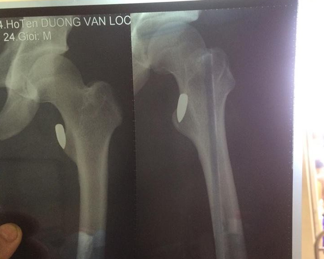 Vĩnh Ph&uacute;c: Vận động vi&ecirc;n v&otilde; thuật Pencak Silat bị tr&uacute;ng đạn sau buổi tập - Ảnh 2.