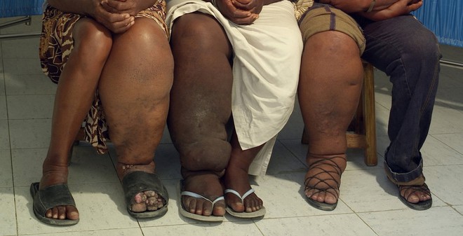 Chuyện của những đôi chân khổng lồ: Cuộc sống như địa ngục của hàng triệu người mắc bệnh chân voi - Ảnh 2.