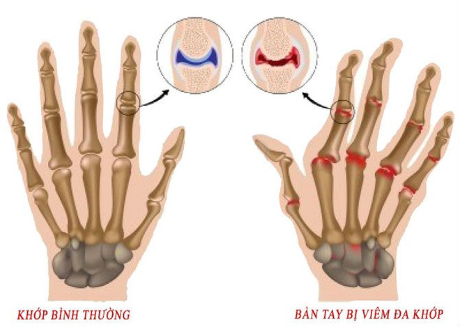 Bi&ecirc;n tập vi&ecirc;n bị hủy khớp tay do&hellip; g&otilde; b&agrave;n ph&iacute;m qu&aacute; nhiều - Ảnh 2.